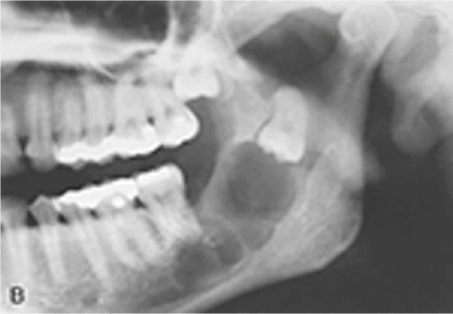 <p>Benign but aggressive tumor w sig recurrence</p><p>Most common in post mand but can be in the ant</p><p>Most common true odontogenic tumor</p><p>multilocular radiolucency (soap bubble)</p><p>often assoc w/ impacted tooth</p>