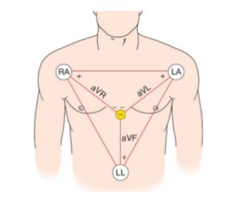 Leads aVR, aVL, aVF

AVL, the left leg and right arm assist with the left arm tracing. In AVR, the left arm and left leg assist with the right arm tracing. In AVF, the right and left arms assist with the left leg tracing.