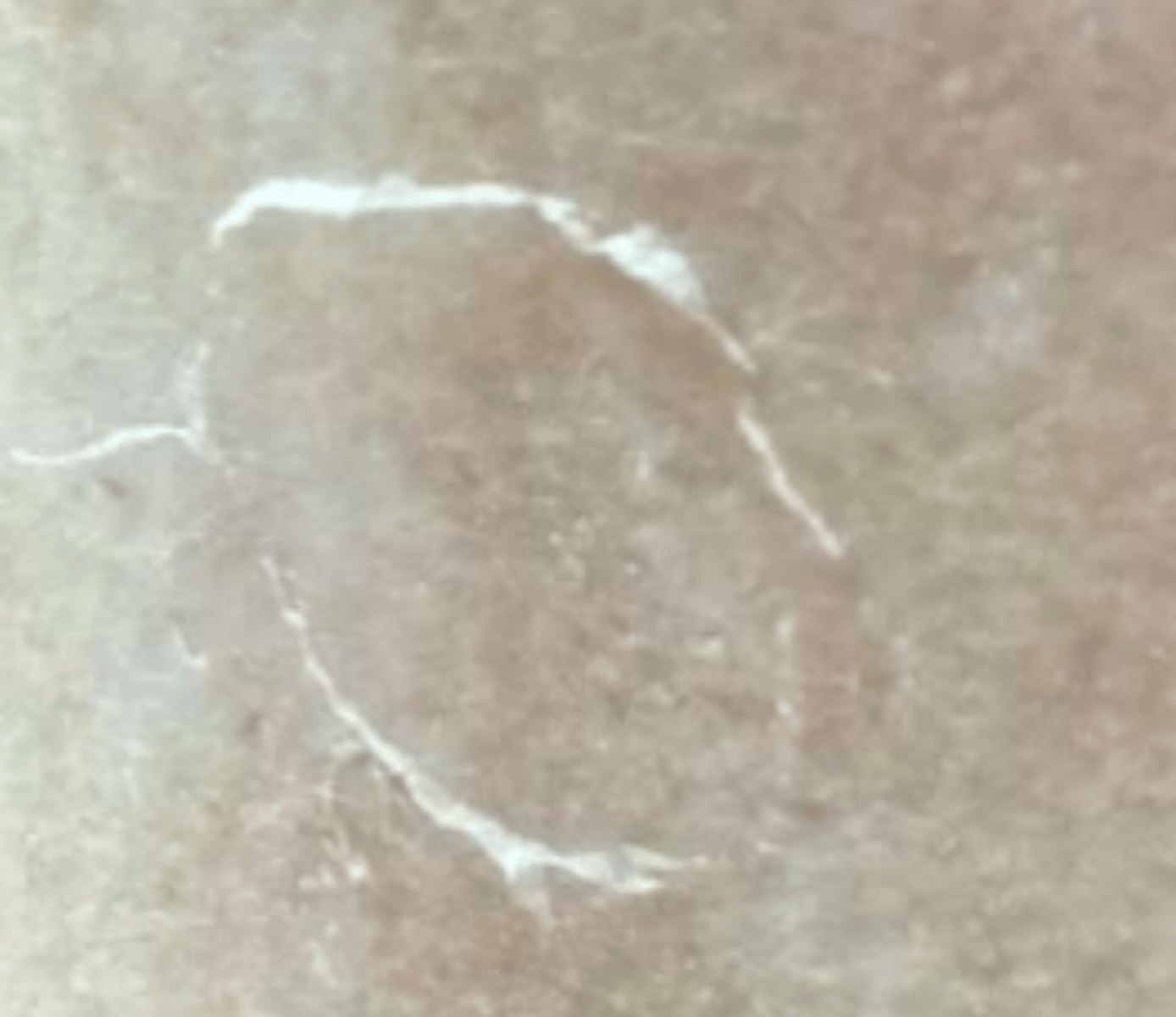 <p>¿lesión?</p><p>¿primaria o secundaria?</p>