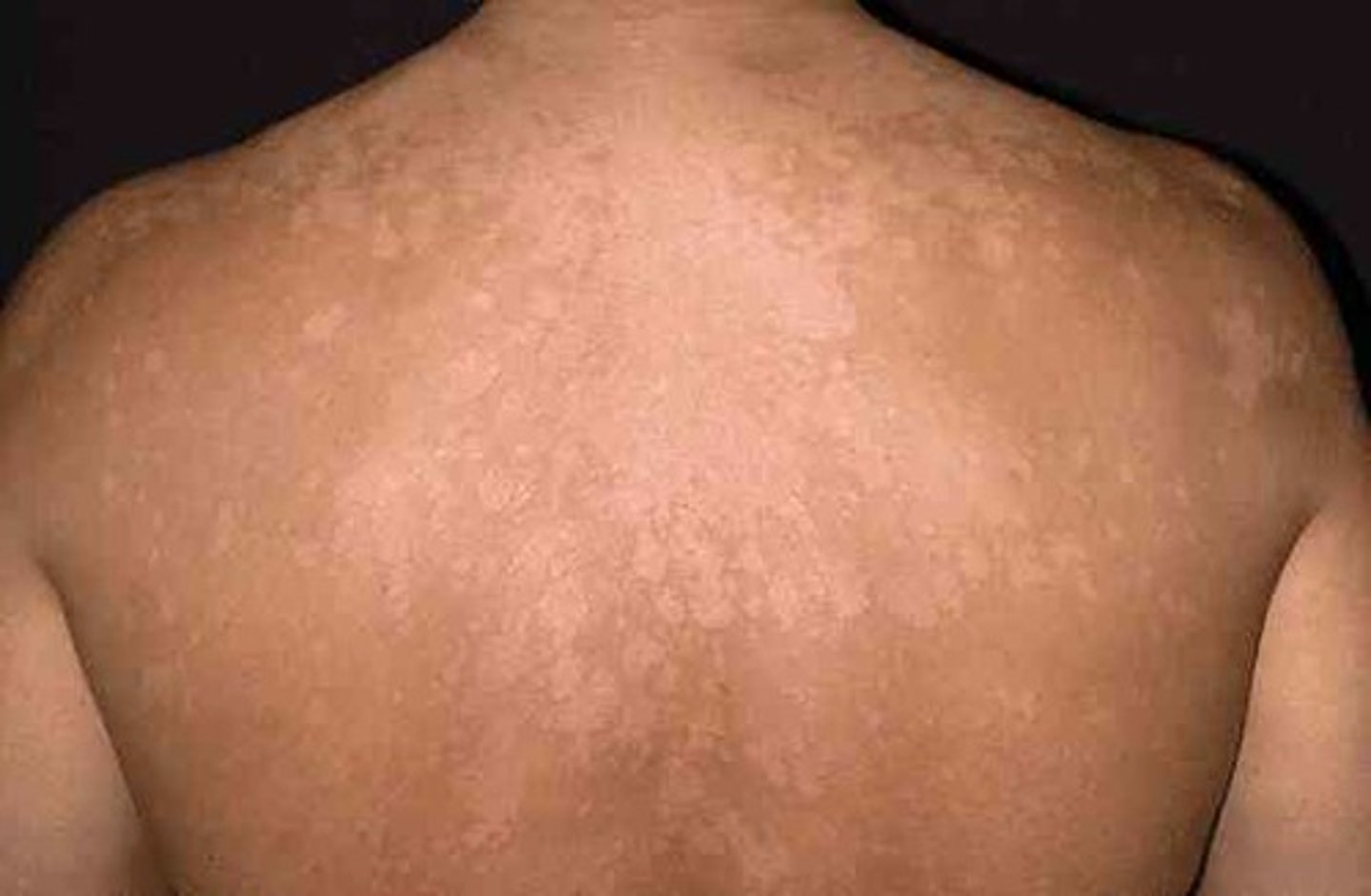 <p>Common superficial fungal infection of the skin causing hypopigmentation, slightly scaly macules on the trunk, neck, and upper arms (short-sleeved distribution)<br><br><b>Note: they are easier to see in darker skinned individuals, in lighter skinned individuals they may be seen as reddish or tan instead of pale</b></p>