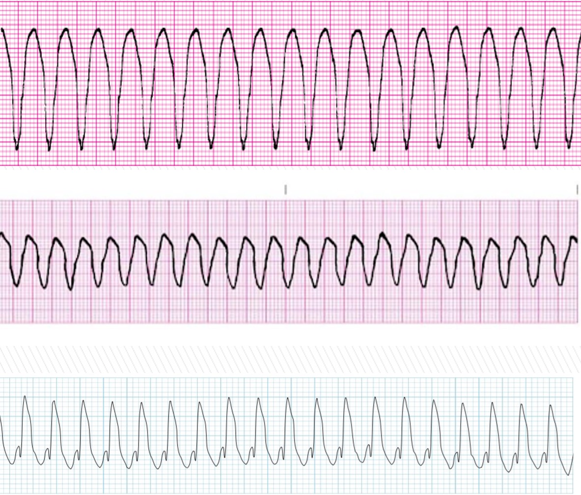 <p>What rhythm does the pictures attached depicts? </p>
