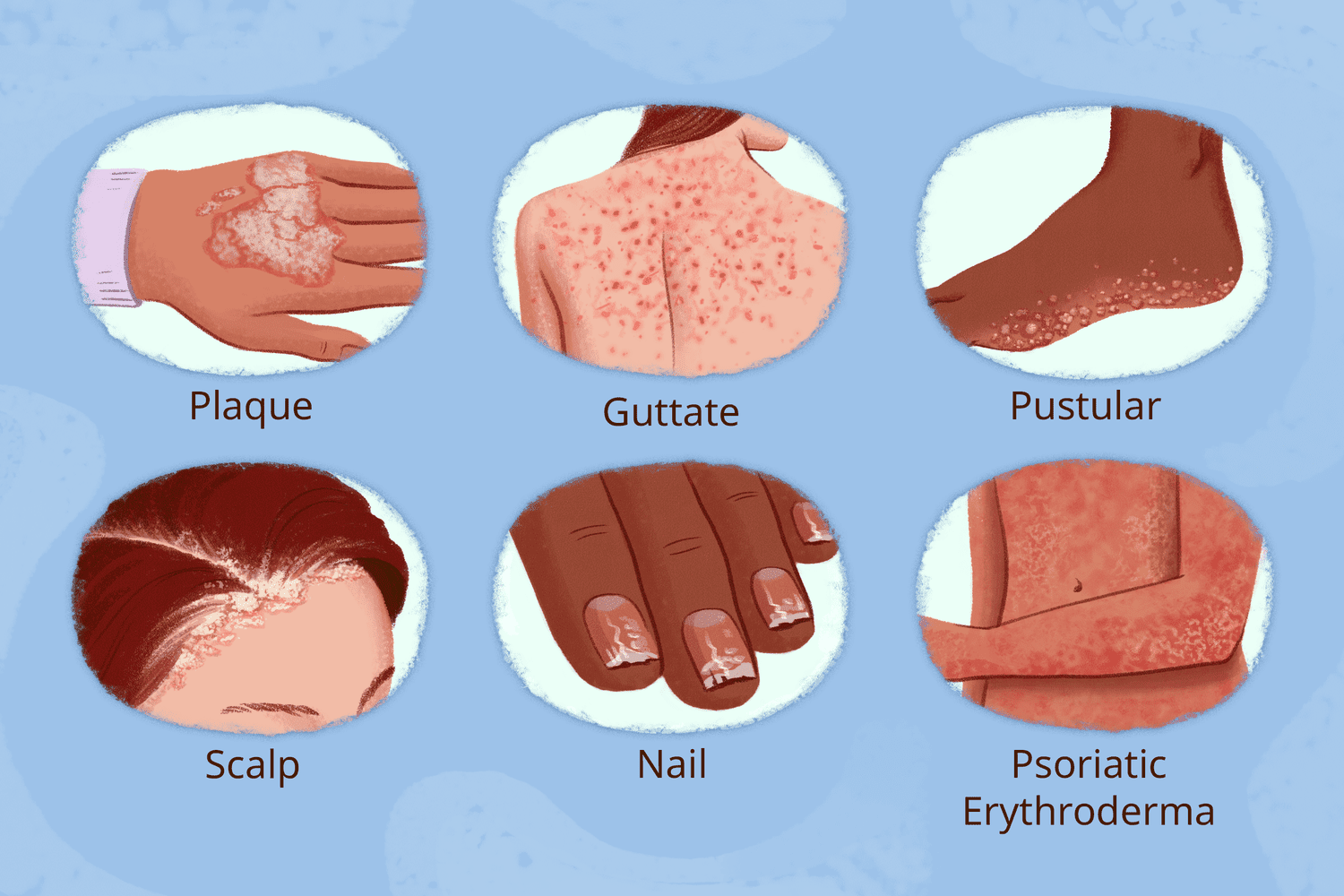 <p>PP: chronic/recurrent inflammatory disease</p><p>E: common<br>scalp<br>nails<br>extensor surfaces<br>umbilical region<br>sacrum<br>1-3% of population</p><p>TX:<br><u>topical:</u><br><strong>1st line→topical steroids</strong><br>topical calcipotriene<br>anthralin+coal tar<br>narrow band UV x 3x/week</p><p><u>systemic:</u><br>methotrexate<br>acute→cyclosporine+taper off<br>PO acitretin<br>apremilast</p><p><u>Biologics:</u><br><strong>TNF alpha inhibitors:</strong><br>-entanercept<br>-adalimumab</p><p><strong>interleukin 12+23 inhibitor:</strong><br>-ustekinumab</p><p><strong>interleukin 17 inhibitors:</strong><br>-ixekizumab<br>-secukinumab</p><p><strong>interleukin 23 inhibitor:</strong><br>-guselkumab<br>-risankizumab<br>-tildrakizumab</p>