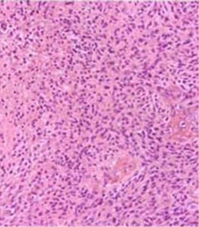 <p>What does this refer to</p><ul><li><p>Confirms dx</p></li><li><p>Malignant astrocytes +necrotizing hemorrhagic center surrounded by pseudopalisading (tumor cells lining necrotic cells)</p></li></ul><p></p>