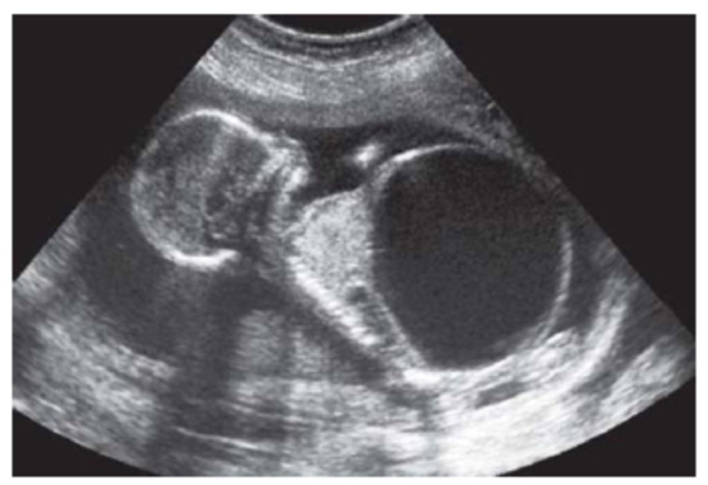 <p>Triad of symptoms:</p><p>Distended abdominal muscles</p><p>Obstruction of urinary tract</p><p>Cryptorchidism</p><p>Distended abdomen</p><p>Enlarged bladder</p><p>Bilateral hydronephrosis</p><p>Oligohydramnios -> hypoplastic lungs</p>