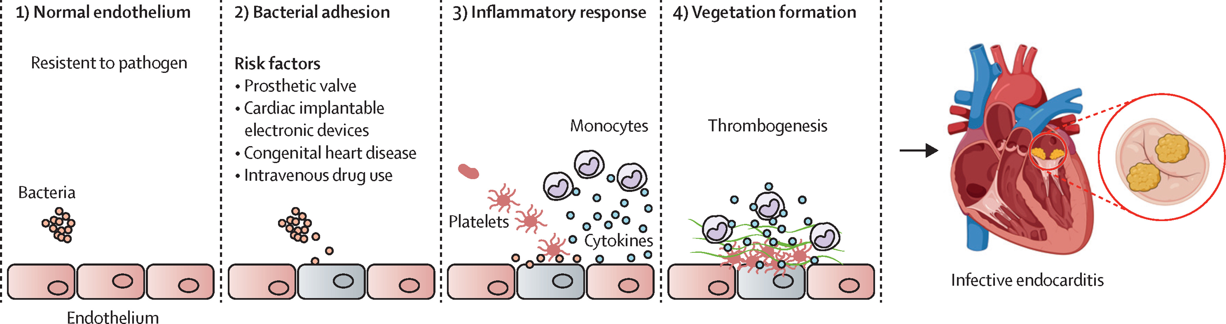 <ol><li><p><strong>Endothelial Damage</strong></p><ul><li><p>Damaged endothelium exposes <strong>collagen and tissue factor</strong>, promoting <strong>platelet-fibrin thrombus</strong> formation</p></li></ul></li><li><p><strong>Bacteremia</strong></p><ul><li><p>Microorganisms (bacteria or fungi) enter the bloodstream via:</p><ul><li><p>Dental procedures</p></li><li><p>Poor gingival health</p></li><li><p>IV drug use</p></li><li><p>Surgery</p></li><li><p>Infected devices (e.g., catheters, prosthetic valves)</p></li></ul></li></ul></li><li><p><strong>Vegetation Formation</strong></p><ul><li><p>Bacteria adhere to the thrombus → form <strong>infected vegetations</strong> composed of <strong>fibrin, platelets, and microorganisms</strong></p></li><li><p>These vegetations are <strong>protected from immune cells</strong>, allowing bacteria to multiply</p></li></ul></li><li><p><strong>Destructive and Embolic Effects</strong></p><ul><li><p>Vegetations can destroy valve tissue</p><p>→ <strong>regurgitation or heart failure</strong></p></li><li><p><strong>Septic Microemboli</strong> (tiny clots or infected material from heart valves) can break off</p><p>→ travel to skin, brain, kidneys, etc.</p><p>→ <strong>infarctions or abscesses</strong></p></li><li><p><strong>Immune complexes</strong> can deposit in tissues</p><p>→ vasculitis, glomerulonephritis</p><img src="https://knowt-user-attachments.s3.amazonaws.com/ad23641c-8ea9-4c3f-881d-a33708eb3c6c.png" data-width="100%" data-align="center" alt="knowt flashcard image"></li></ul></li></ol><p></p>