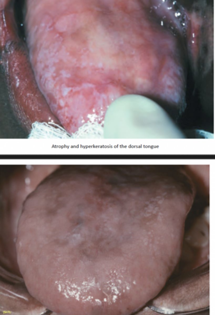 <p>tongue and buccal mucosa bullae and erosions become leukoplakic lesions which are premalignant (1/3 become malignant)</p>