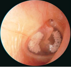 Cicatriz en el tímpano (puede ser post-otitis)