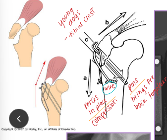 <ul><li><p><span style="background-color: transparent;"><u><span>primary distractive forces</span></u></span></p></li><li><p><span style="background-color: transparent;"><strong><span>Why: </span></strong></span><span style="background-color: transparent; color: red;"><span>Converts </span><u><span>distractive into compressive forces</span></u></span></p><ul><li><p><span style="background-color: transparent;"><u><span>Patellar, Traction physeal, Olecranon fractures, Tibial crest avulsion</span></u></span></p></li></ul></li><li><p><span style="background-color: transparent;"><strong><span>What</span></strong><span>: Kirschner wires + </span><u><span>figure-of-eight</span></u><span> cerclage wire (18-22g)</span></span></p></li></ul><p></p>