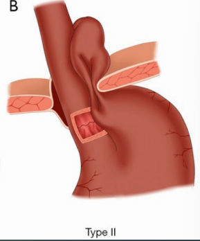 <p><strong>Type II: Paraesophageal Hernia (________ hernia)</strong></p><p>-Herniation of the gastric ______ alongside the ___________, with the GEJ remaining _____ the diaphragm </p><p>-______ is uncommon because the sphincter mechanism is intact </p><p>-Can cause congestion of mucosal blood flow leading to gastritis and ______</p><p>-Strangulation can occur, causing __________ and necrosis </p>