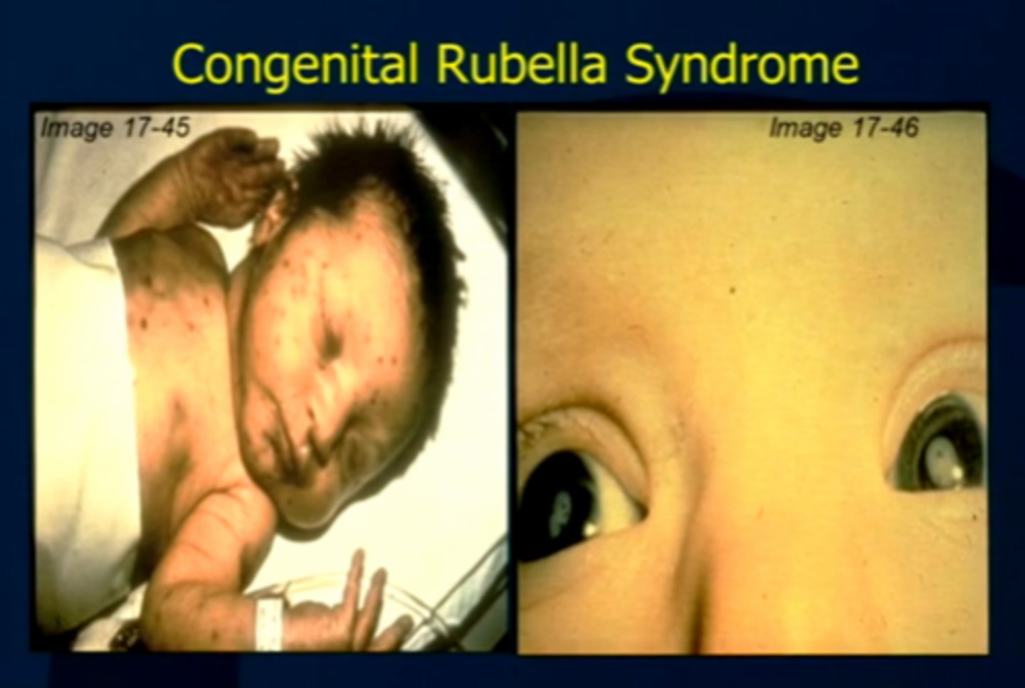 <p>A birth defect that occurs when the mother becomes infected with the rubella virus in her first trimester</p><p>Hearing loss, heart defects, eye anomalies</p>