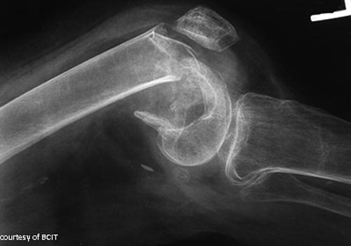 <p>What causes femoral condyle fractures?</p>