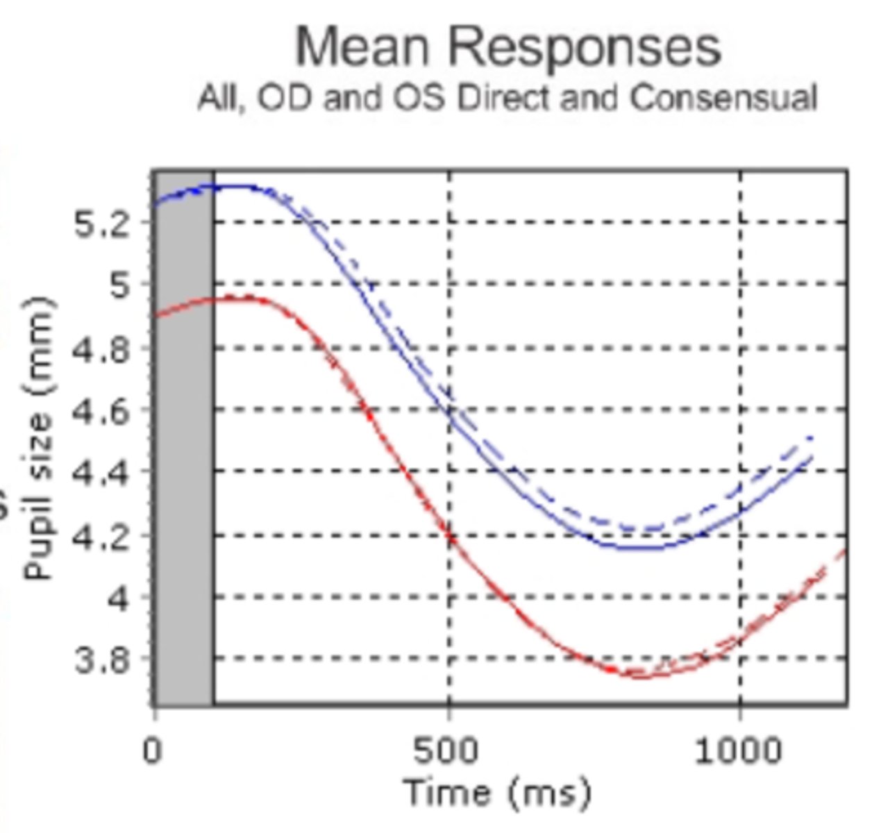 <p>anisocoria is present bc of unequal pupil sizes, but both pupils show the same latency and velocities so there is no APD</p>