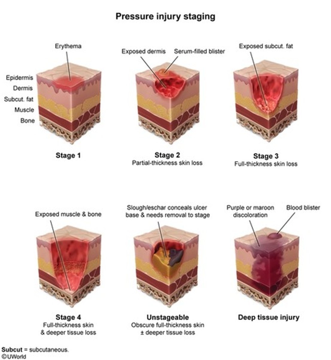 <p>Stage 1: intact skin with non-blanchable redness</p><p>Stage 2: Partial thickness wound. Superficial in nature with pink/red wound bed (shallow crater)</p><p>Stage 3: full thickness wound. Subcutaneous fat tissue visible but no bone, tendon and muscle exposed (deep crater). Slough/eschar present. Undermining and tunneling may occur. FAT three letters, stage 3</p><p>Stage 4: Full thickness with exposed bone, tendon or muscle. Slough/eschar present. Undermining and tunneling often occur.</p><p>Unstageable: wound bed covered with slough/eschar (unable to identify the depth)</p><p>Deep tissue injury: intact skin purple maroon appearance. Something was injured but the skin was intact, like a bruise.</p><p>Stage 1: reddened area that doesn't go away</p><p>Stage 2: First 2 layers of skin. Superficial in nature</p><p>Stage 3: Fat. Down to fascia</p><p>Stage 4: bone</p>