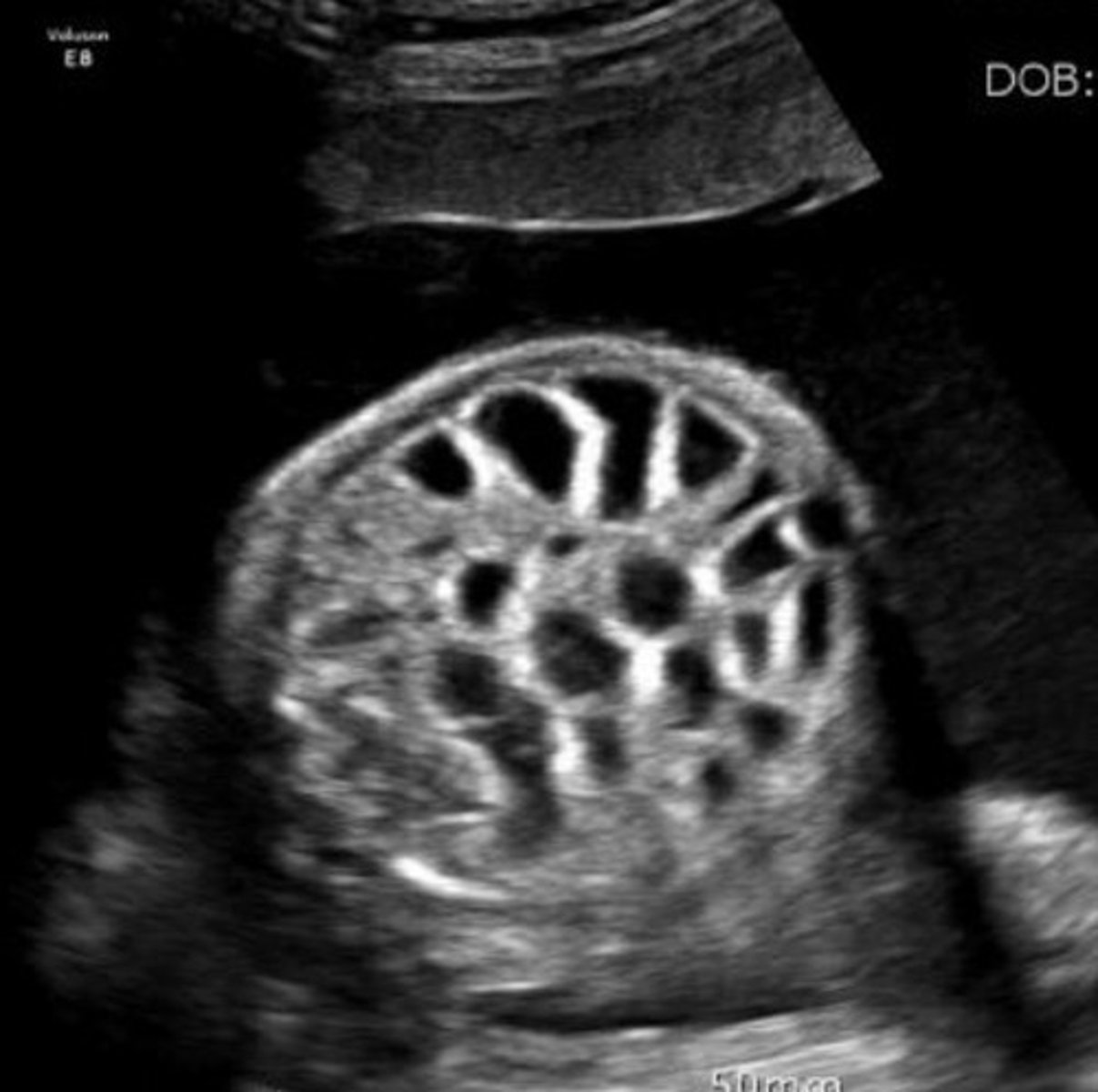 <p>Atresia of jejunum and/or ilium</p><p>Dilated bowel</p>