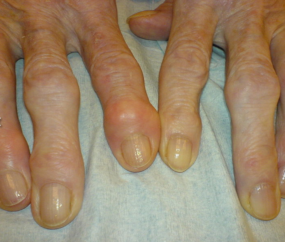 <ul><li><p>Pain in the affected joint exacerbated by use</p></li><li><p>Crepitus→ friction between bone and cartilage</p></li><li><p>Limping/antalgic giant</p></li><li><p>Herberdens nodes on DIP</p></li><li><p>Bouchards nodes on PIP</p></li></ul><p></p>