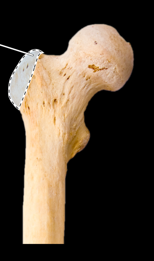 <p>Femur, anterior view, right side, proximal end</p>