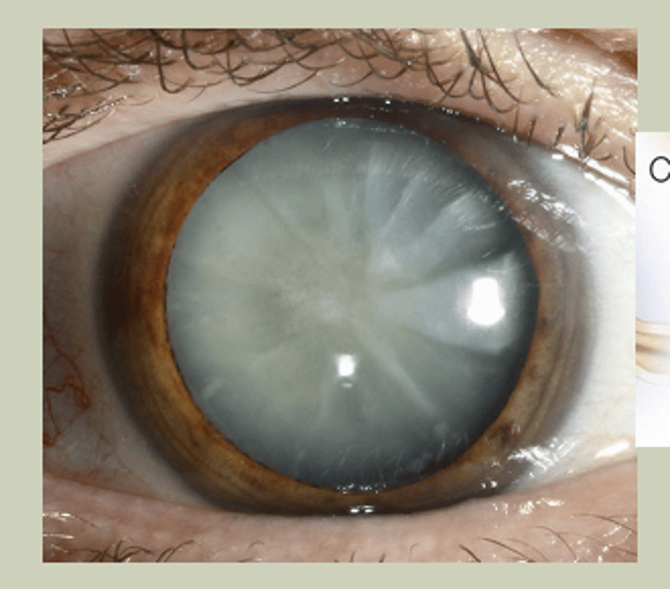 <p>-Older pts, bilaterally</p><p>-Gradual onset</p><p>-Extraction may be indicated if affecting ADL's</p>