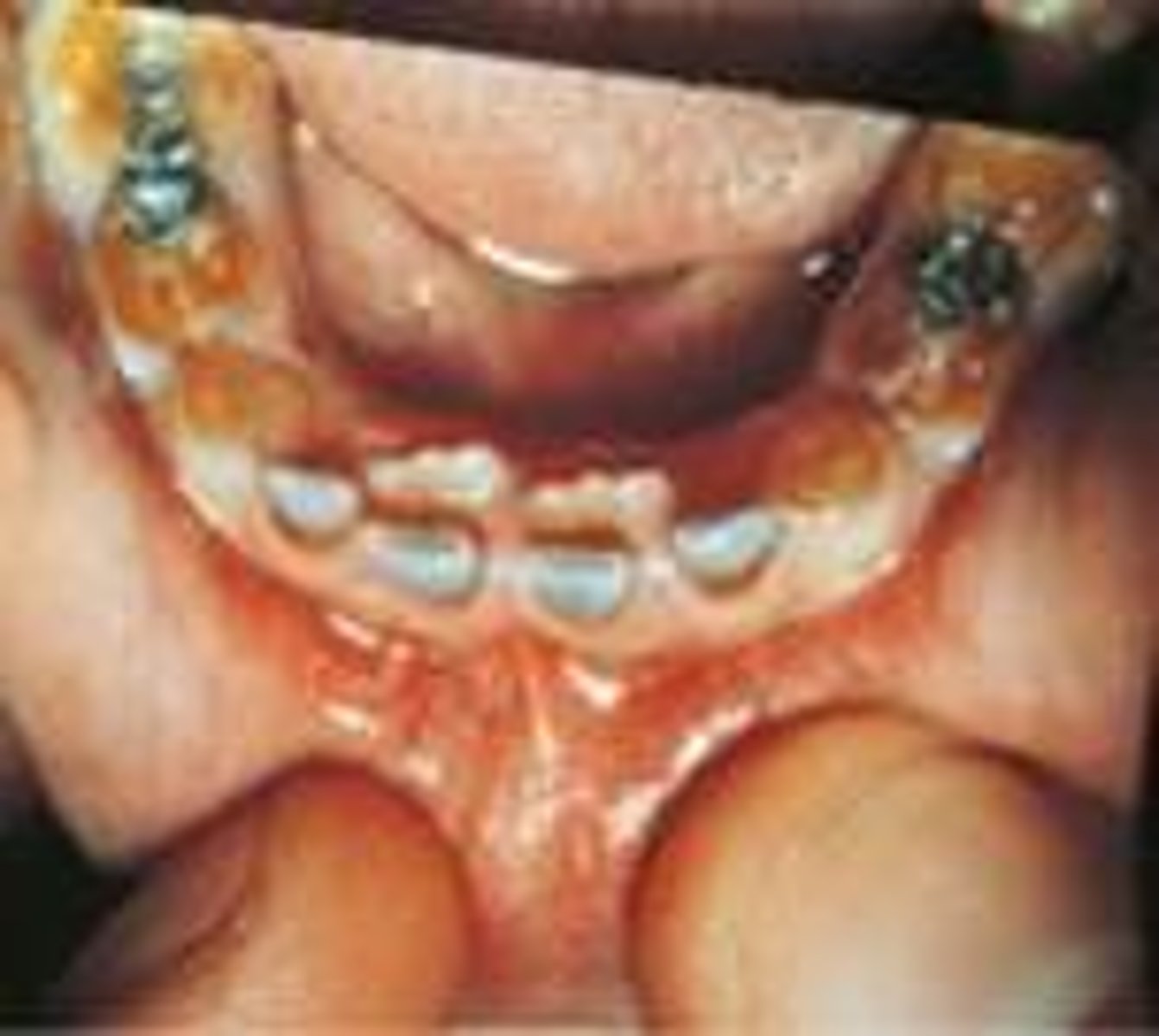 <p>Dentinogenesis Imperfecta</p>