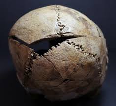 <p>Sharp Force Trauma</p>