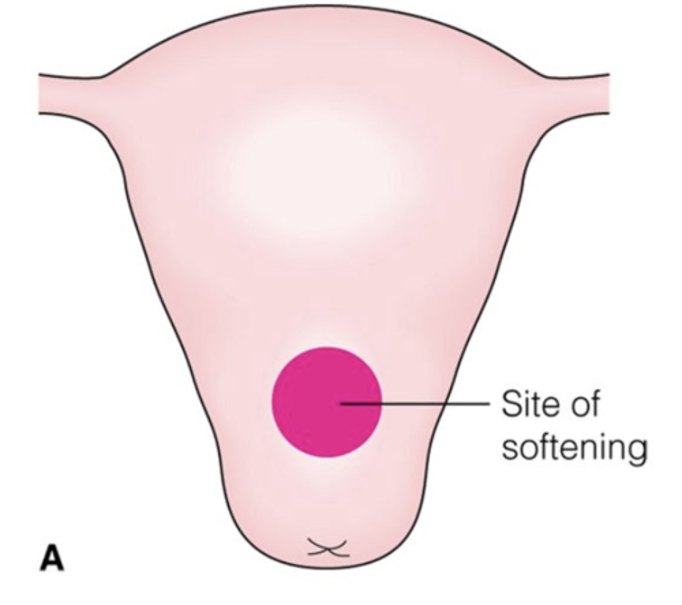 <p>A) Ladin sign</p><p>Explanation: </p><p>A) The Ladin sign is a soft spot anteriorly in the middle of the uterus near the junction of the body of the uterus and the cervix. The Braun von Fernwald sign is an irregular softening and enlargement at the site of implantation. Piskacek's sign is a tumorlike asymmetric enlargement of the uterus. Goodell sign is caused by increased vascularization, which softens the cervix.</p>