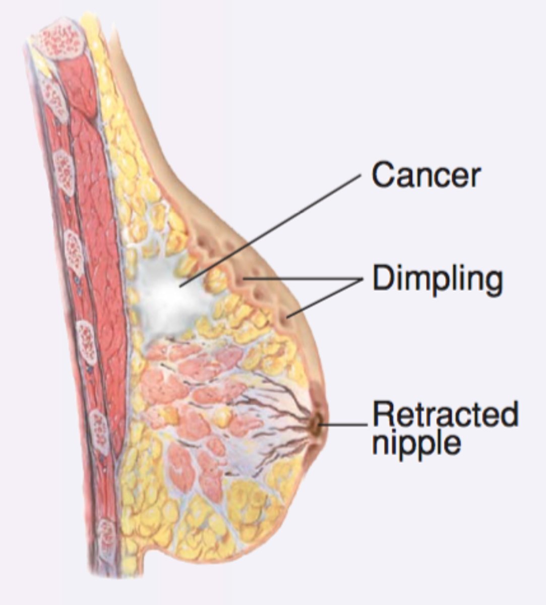 <p>are caused by fibrosis in the breast tissue, usually caused by growing neoplasms. The fibrosis shortens with time, causing contrasting signs with the normally loose breast tissue.</p><p>Note a lag in the movement of one breast.</p>