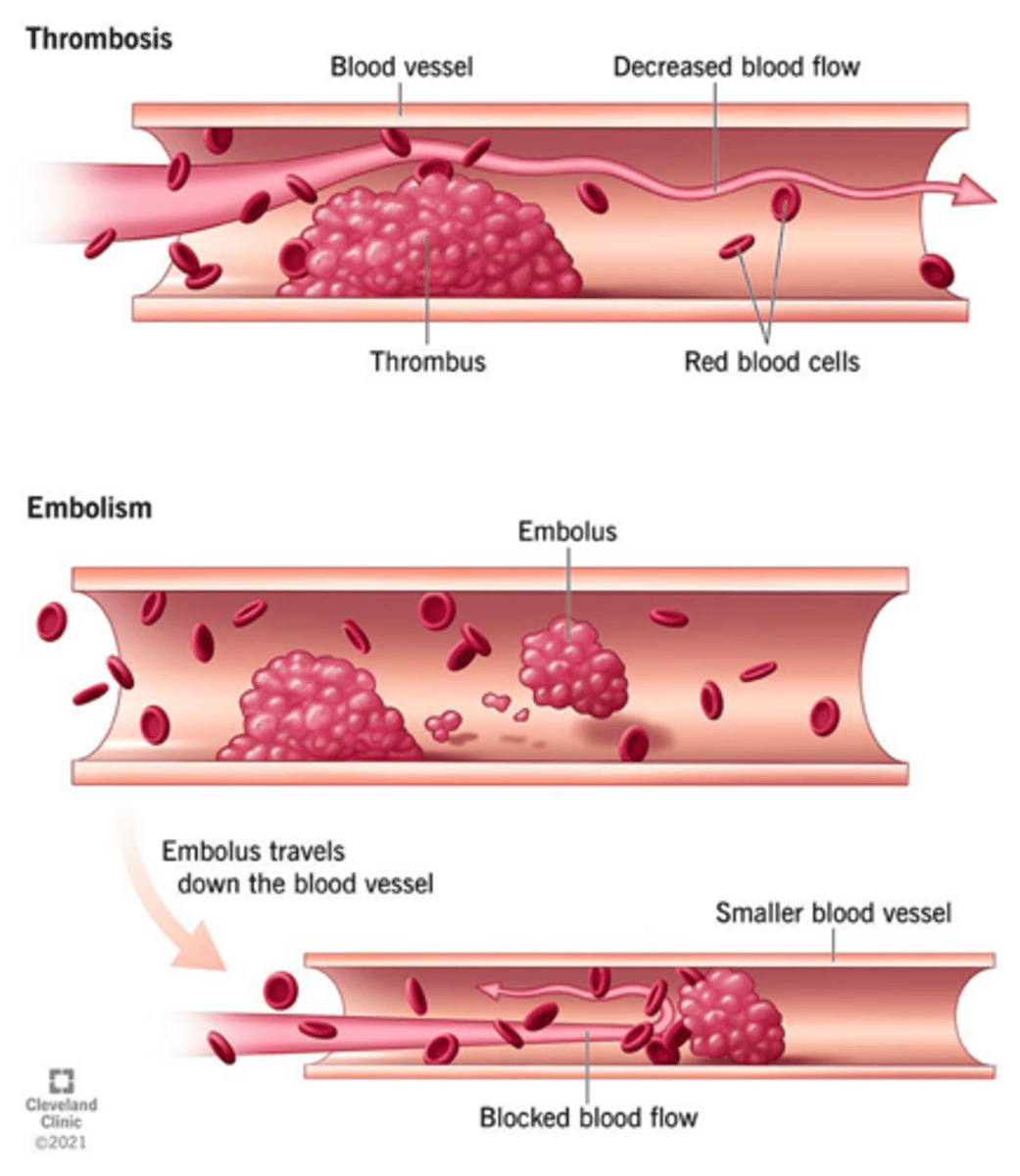 <p>Deep vein thrombosis (DVT) and pulmonary embolism (PE)</p>