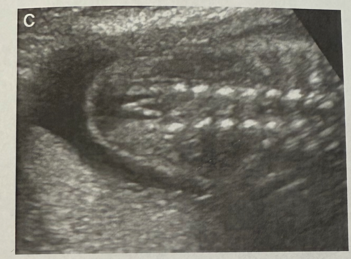 <p><span>What is the plane of this spine?</span></p><ol><li><p><span>﻿﻿﻿Sagittal spine</span></p></li><li><p><span>﻿﻿﻿Transverse spine</span></p></li><li><p><span>Coronal spine</span></p></li></ol>