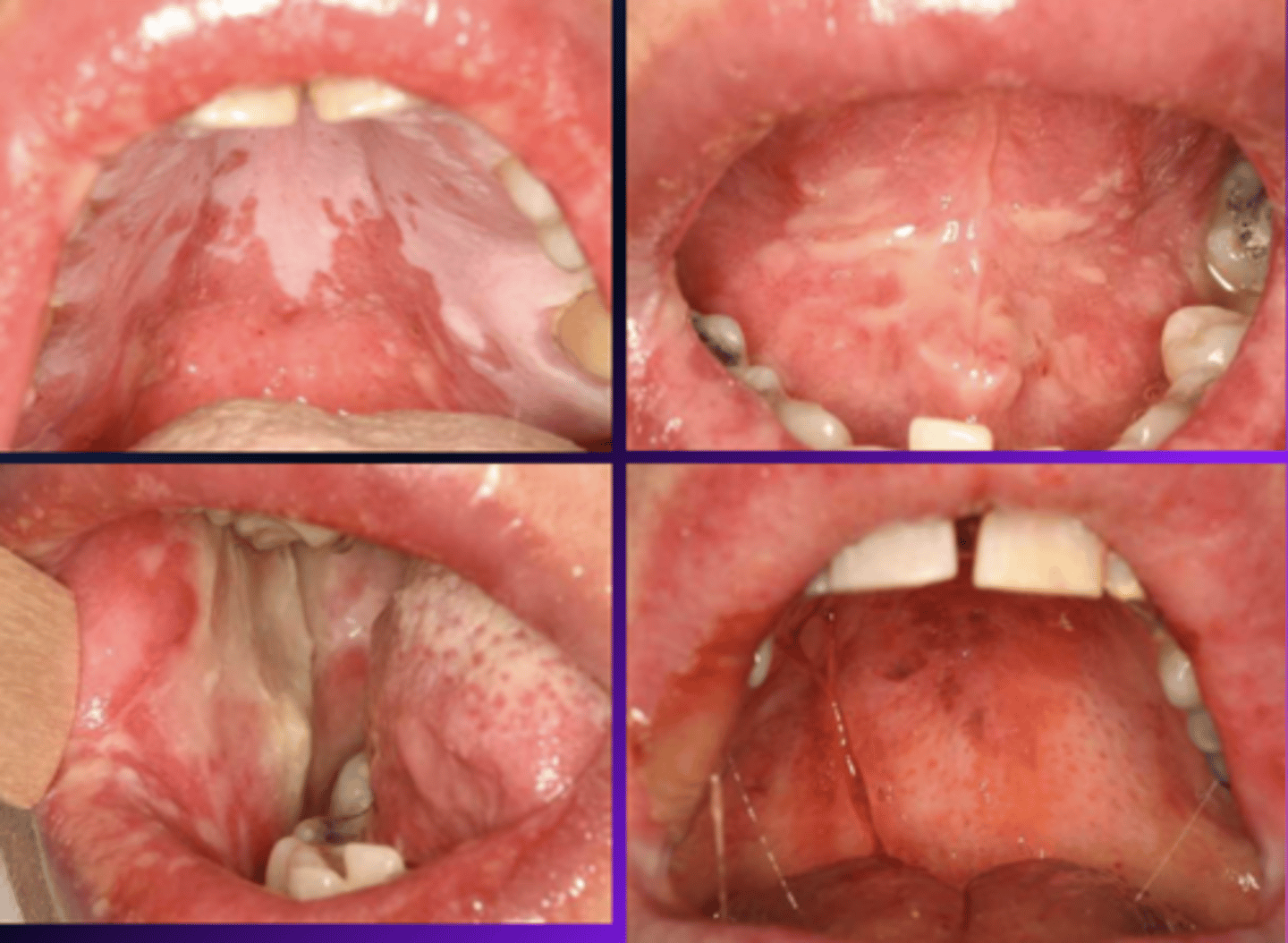 <p>Patient presents with these oral lesions and recently received an allogeneic hematopoietic stem cell transplant. What is the most likely differential?</p>