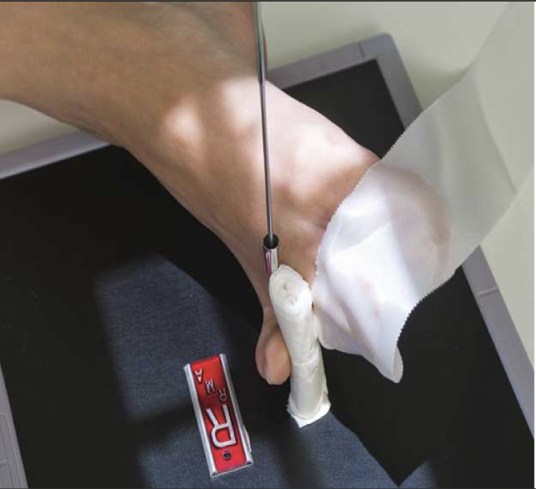 <p>Patient Position </p><p class="p1"><span style="line-height: normal;"><span> </span></span>Same as AP &amp; oblique</p><p class="p1"></p><p class="p1">Part Position</p><p class="p1"><span style="line-height: normal;"><span> </span></span>1<span style="line-height: normal;"><span>st</span></span> ,2<span style="line-height: normal;"><span>nd</span></span> &amp; 3<span style="line-height: normal;"><span>rd</span></span> rotated onto medial surface</p><ul><li><p class="p1"><span style="line-height: normal;"><span>&nbsp;</span></span>Lateromedial projection</p></li></ul><p class="p1"><span style="line-height: normal;"><span> </span></span>4<span style="line-height: normal;"><span>th</span></span> &amp; 5<span style="line-height: normal;"><span>th</span></span> rotated onto lateral surface</p><ul><li><p class="p1"><span style="line-height: normal;"><span>&nbsp;</span></span>Mediolateral projection</p></li></ul><p class="p1"></p><p class="p1"> CR</p><p class="p1"><span style="line-height: normal;"><span> </span></span>CR perpendicular to PIP or IP ( 1<span style="line-height: normal;"><span>st</span></span> toe)</p><p class="p1"></p><p class="p1"> Collimation</p><p class="p1"><span style="line-height: normal;"><span> </span></span>Same as AP &amp; oblique</p>