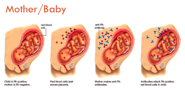 <ul><li><p><span>Does not happen during the first pregnancy--happens to Rh neg women</span></p></li><li><p><span>Type O moms have the highest risk of HDFN regardless of Rh neg/pos status</span></p></li><li><p>rhogam is used to treat—”hides” the baby’s D antigen from the mother </p></li></ul><p></p>