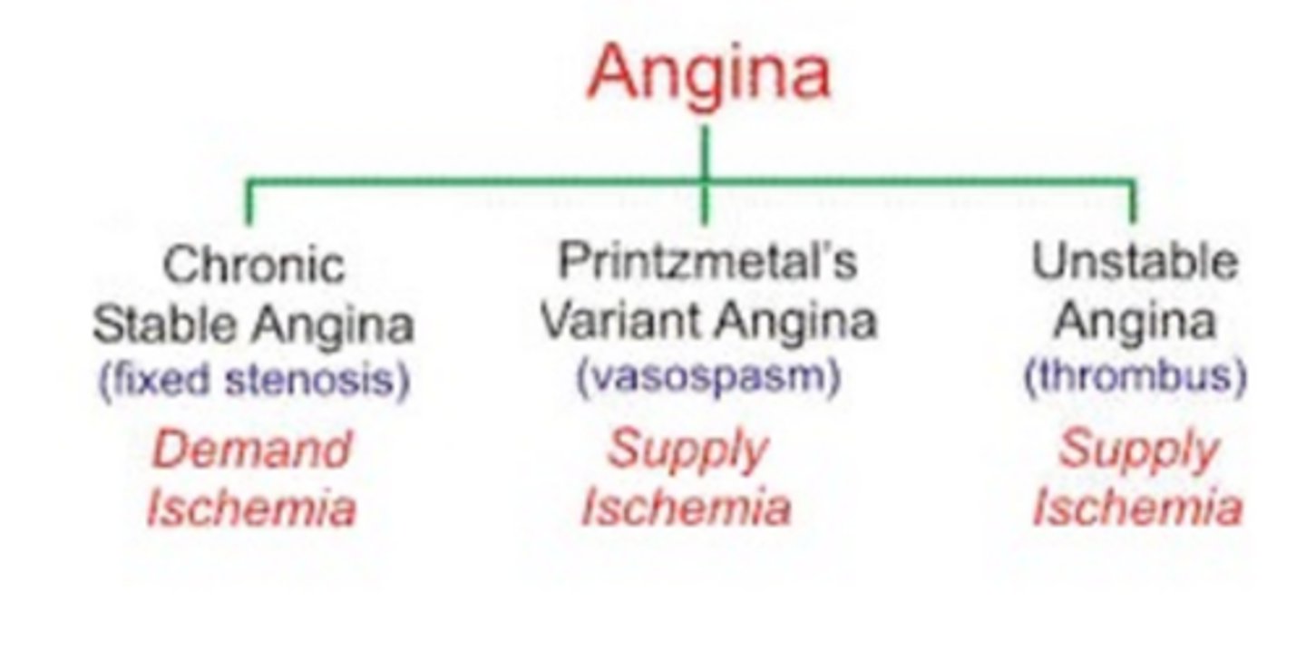 <p>Classic angina presents with substernal chest pain that’s described as “squeezing” or “pressure-like.” **Levine’s sign**</p><p>Can radiate to the arms or jaw and is made worse by exertion or emotion and made better by rest or nitroglycerin</p>