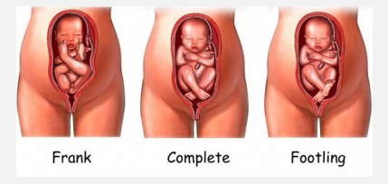 <p><strong>Breech Presentation</strong></p><p>-Either the bottom or ____ are the first body parts that make contact with the _____</p><p>-Complete → ________ and feet are next to each other with bent knees&nbsp;</p><p>-Frank → buttock first, feet by the ____</p><p>-Footling → _____ first, single or double</p><p>-Kneeling → ______ first&nbsp;</p>