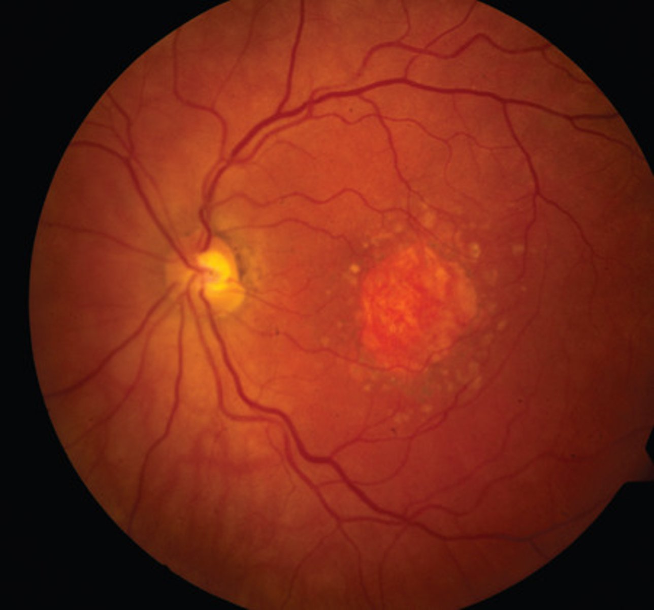 <p>Relatively common</p><p>•Results from the absence of melanin in the RPE (RPE is present)</p><p>•Round, well circumscribed, white/yellow area</p><p>•No surrounding RPE hyperplasia (unlike in chorioretinal scar)</p><p>•Differentiate from retinal holes which appear red/brown with oedema</p><p>and/or hyperplasia</p>