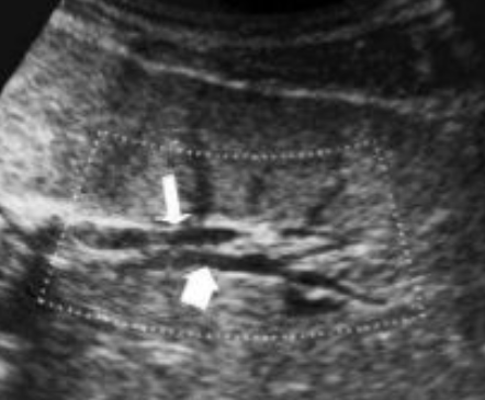 <ul><li><p>aka Parallel Channel Sign</p></li><li><p><span>see dilated branches of intrahepatic ducts</span></p></li><li><p><span>see bile ducts running next to even distal portal branches—these ducts not seen unless dilated.</span></p></li></ul>