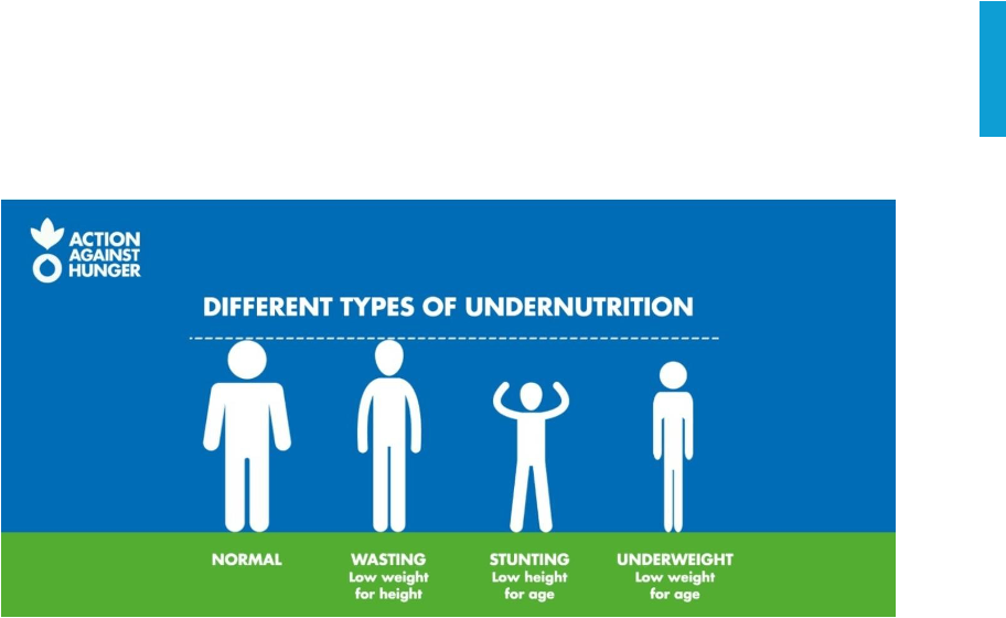 <p><span>•Acute and Chronic under nutrition.</span></p><p><span>•Children can have a combination of both &nbsp;acute and chronic under nutrition.</span></p><p><span>••Acute under nutrition is categorized into &nbsp;Moderate and Severe acute under&nbsp;nutrition, determined by the client's &nbsp;degree of wasting (<em>is an indicator of acute &nbsp;undernutrition, the result of more recent &nbsp;food deprivation or illness</em>).</span></p><p><span>•All cases of bi-lateral oedema are &nbsp;categorized as severe acute under&nbsp;nutrition.- both sides- indicates lympatic system is non fuctional- need hospital</span></p><p></p><p><span>Normal is meeting the WHO growth standards</span></p>