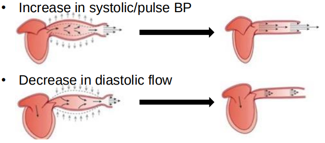 <ul><li><p>Age related </p></li><li><p>Exacerbated by hypertension</p></li><li><p>Due to loss of elastin. Elastin replaced by collagen</p></li><li><p>Consequence: Increase in cardiac workload</p></li></ul><p></p>