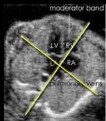 <p>the fetal heart normally sits at a ___ degree angle in the chest with the <strong>apex</strong> pointed toward the <strong>left anterior</strong> chest wall</p><p>a) 30</p><p>b) 45</p><p>c) 60</p><p>d) 90</p>