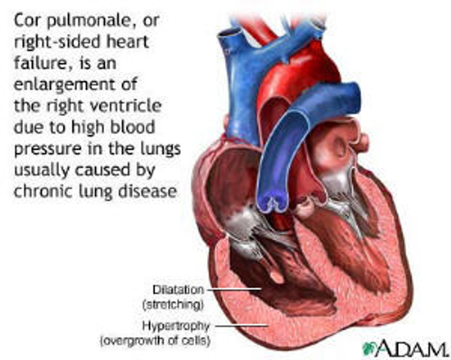 <p>-right sided heart failure caused by high blood pressure</p><p>-caused by respiratory disorders especially COPD</p>