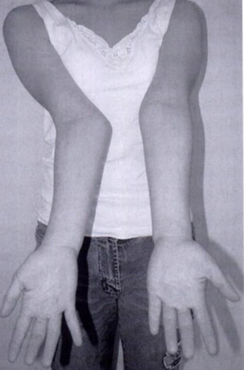 <p>An abnormal outward/lateral deviation at the elbow</p>