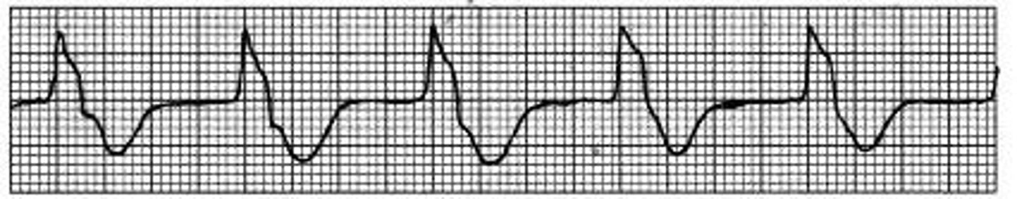 <p>Rate: slow 20-40</p><p>P waves: absent</p><p>P-R: N/A</p><p>QRS: wide &gt; 0.12</p><p>Rhythm: regular</p>