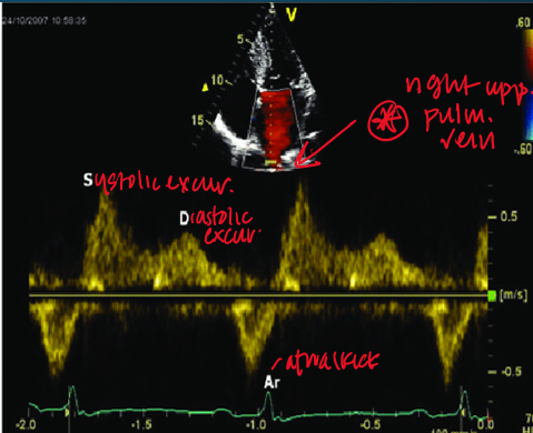 <ul><li><p>in 4CH view you can see paralel alignment with right superior pulmonary vein </p></li><li><p>pulsed wave doppler </p></li><li><p>1-2cm from orifice </p></li></ul><p></p>