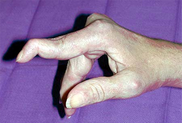 <p>A patient with rheumatoid arthritis presents with hyperextension of the proximal interphalangeal (PIP) joints and flexion of the distal interphalangeal (DIP) joints in several fingers. What condition does this describe?</p>