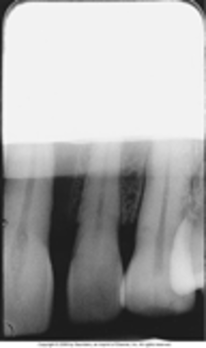 <p>A straight white border due to underdeveloped portion. Film not completely immersed in developer.</p>