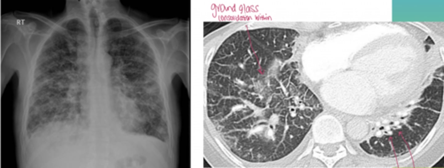 <p>Patient has a history of recent breast cancer, has been experiencing some dyspnea and has abnormal lung function tests, got an x-ray a few months ago but it showed nothing. Got another x-ray and this is what shows- but overall lung architecture is preserved</p>