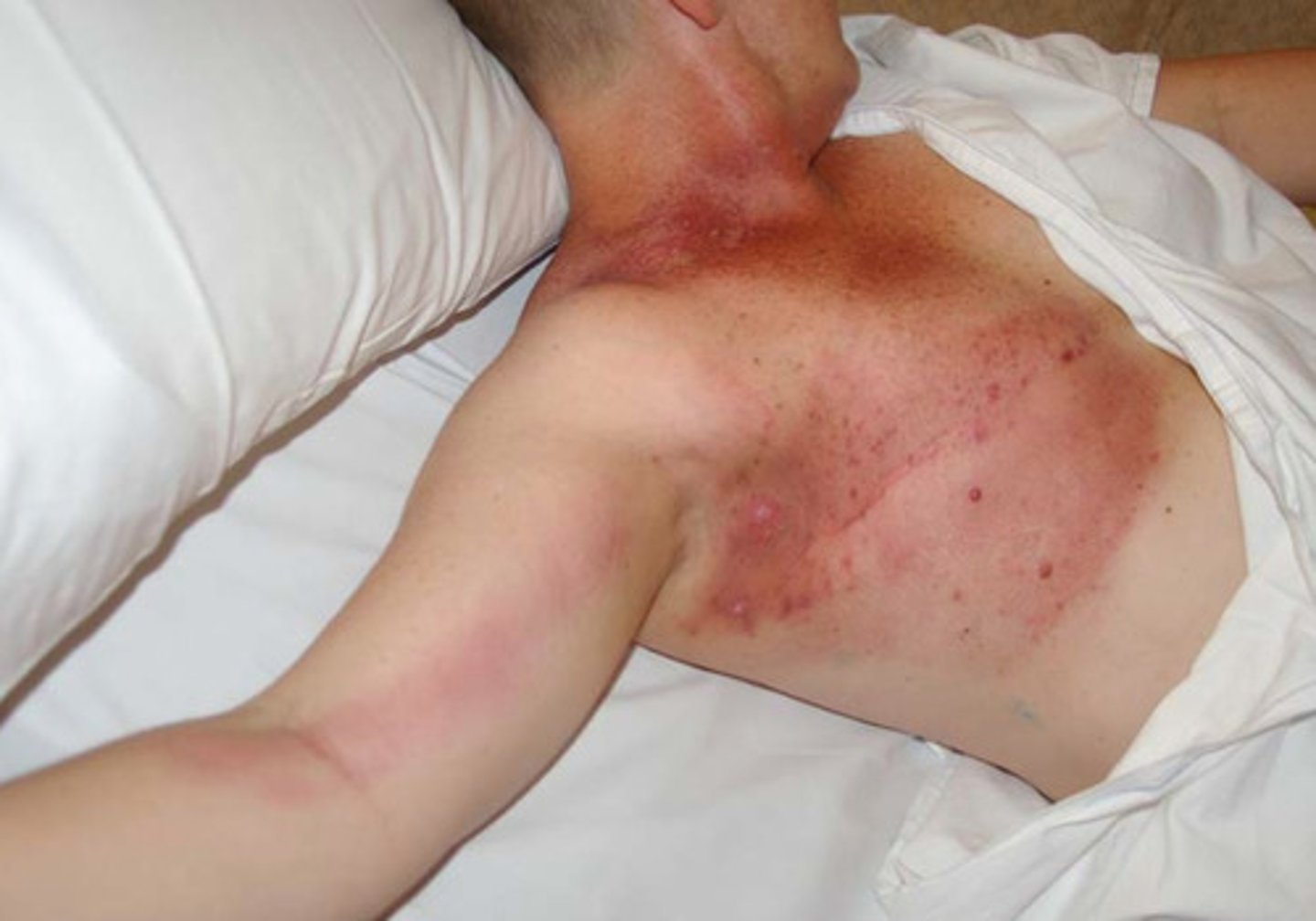 <p>infection of lymph vessel walls that occurs in some acute pyogenic infections in which the microbes in the lymph draining from the area infect and spread along the walls of lymph vessels</p>