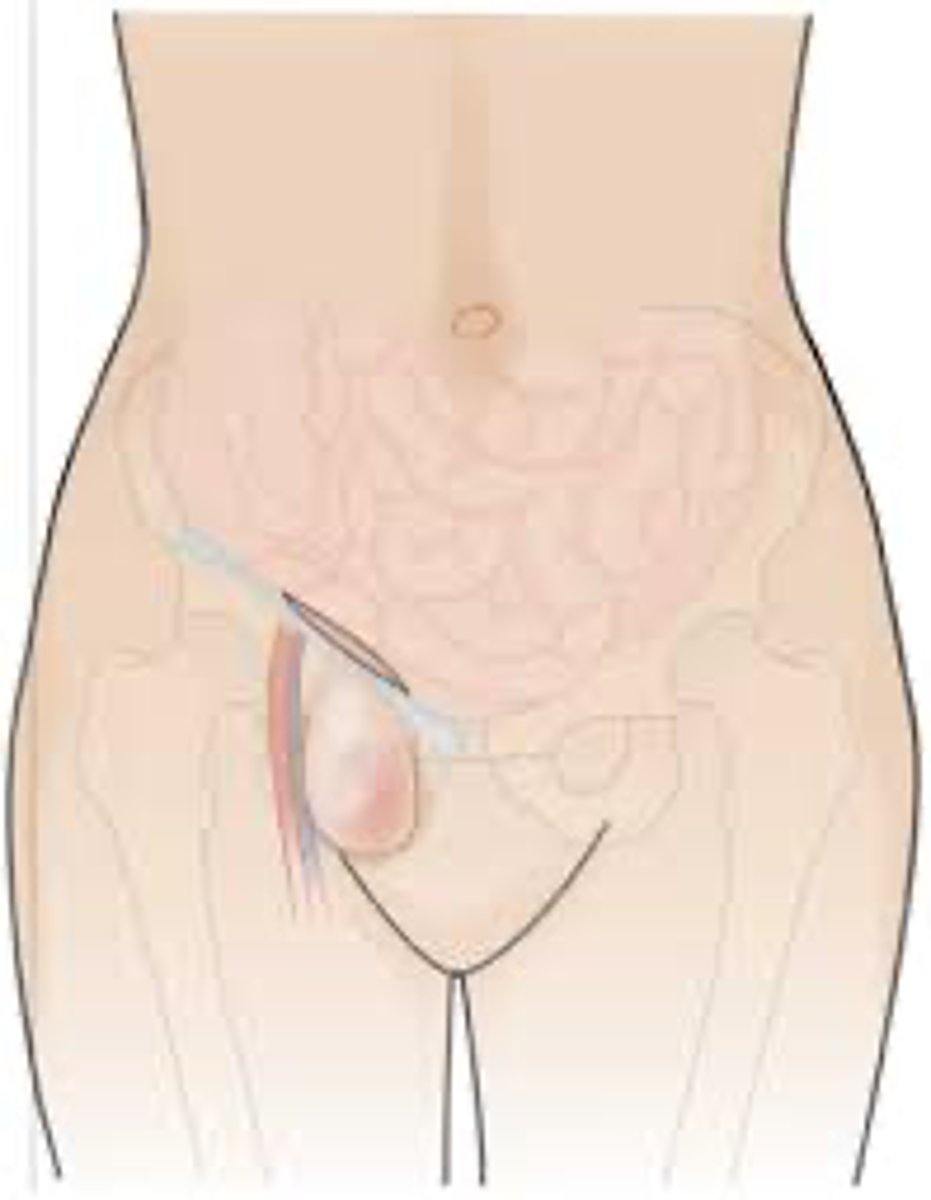 <p>DEFINITION</p><p>Below inguinal ligament</p>
