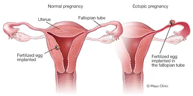 <ul><li><p>A pregnancy that can't be carried to term because the fertilized egg grows outside the uterus</p></li><li><p><span>Symptoms include light bleeding from the vagina, pain in the pelvis, shoulder pain can occur if blood leaks from the fallopian tube</span></p></li></ul>