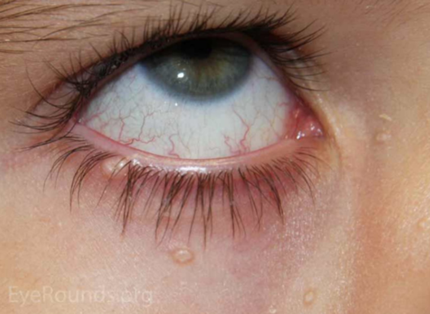 <p>infectious pox virus = intracytoplasmic molluscum bodies form in epithelial cells where virus replicates = multiple small flesh-coloured, waxy papules with umbilicated center that continues to release virus</p><p>+/- follicular conjunctivitis</p>