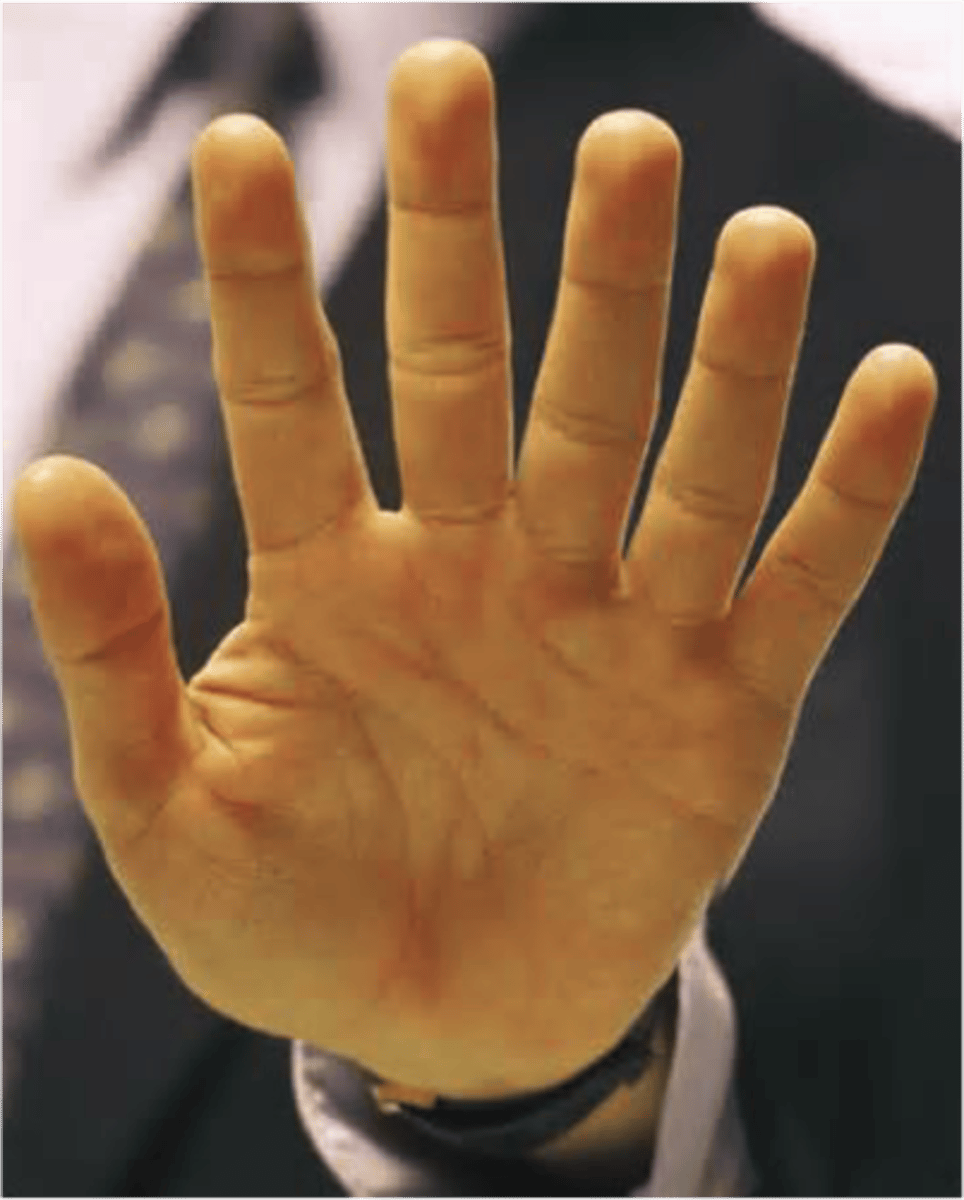 <p>extra fingers including vestigial remnants that are on the ulnar side of hand or lateral side of foot. The most common type of polydactyly, and the most frequently associated with genetic syndromes</p>