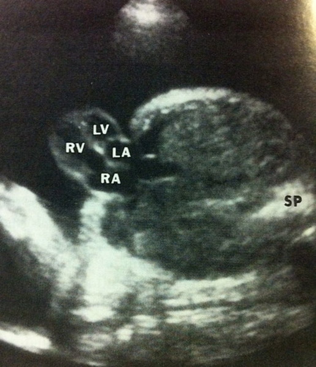 <p>Heart is partially/completely outside chest wall</p>